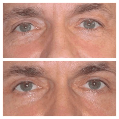 What to Expect During Eye Bag Fat Removal Surgery