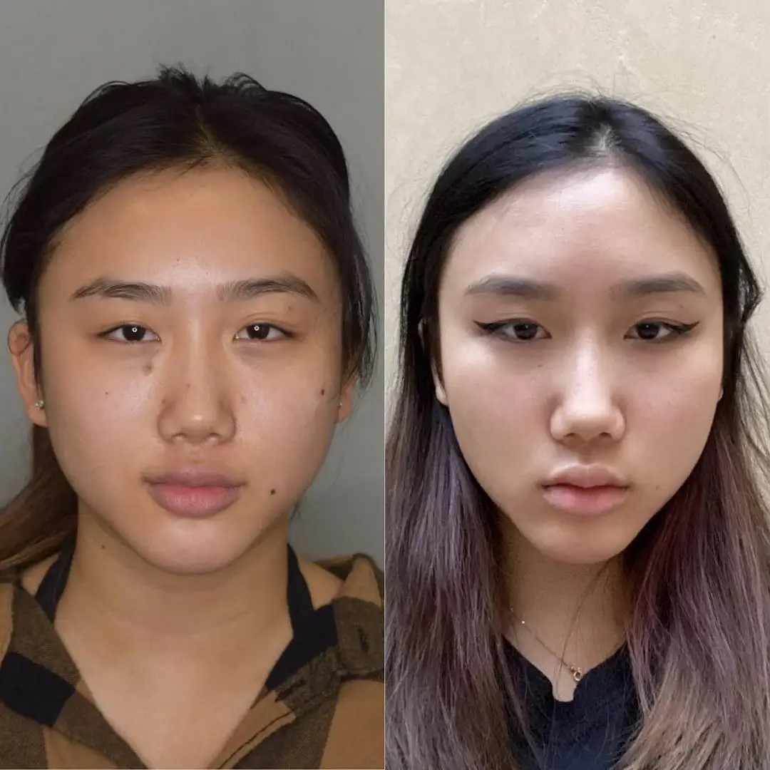 How to Sleep After Buccal Fat Removal Surgery